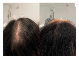 EN SUCCÉ för tjockt hår